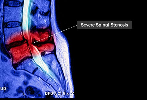 Severe Spinal Stenosis